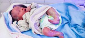 ولادة طفل بحالة طبية نادرة بالفيوم 2 ولادة طفل بحالة طبية نادرة بالفيوم