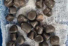 استخراج 58 حصوة من كلية مريض في عملية دقيقة بمستشفى الجامعي بقنا