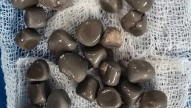 استخراج 58 حصوة من كلية مريض في عملية دقيقة بمستشفى الجامعي بقنا 2 استخراج 58 حصوة من كلية مريض في عملية دقيقة بمستشفى الجامعي بقنا